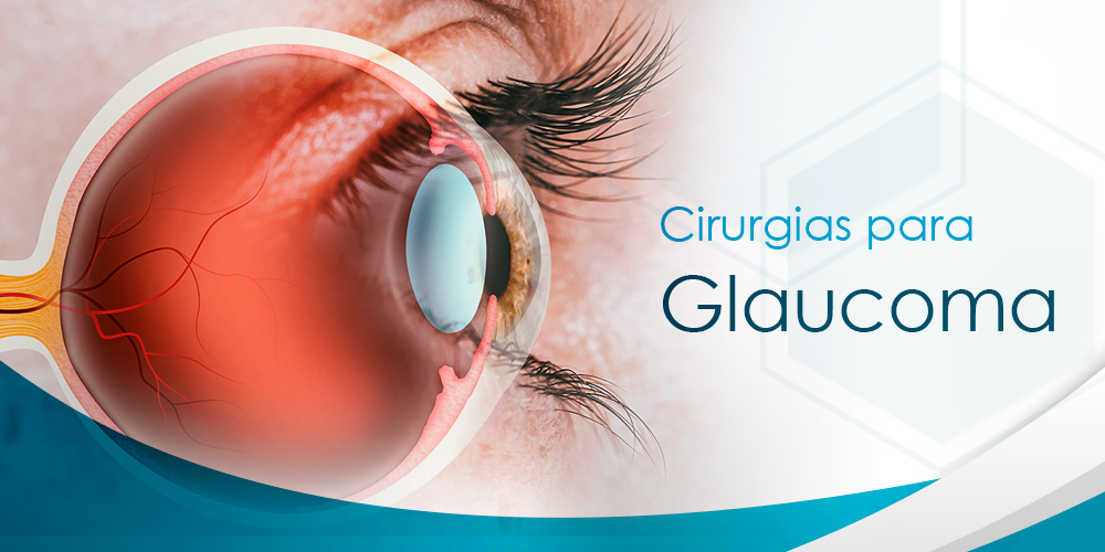Cirurgia de Glaucoma em Belo Horizonte